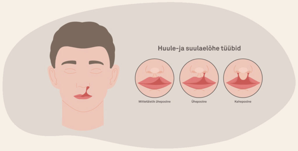 suulaelõhe